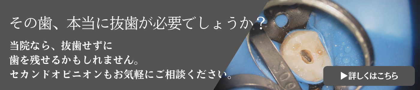 抜歯相談・セカンドオピニオン