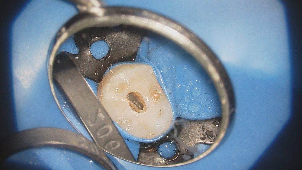 自費と保険の根管治療・精密根管治療の違いを歯科医師が解説！成功率？マイクロスコープ？ラバーダム？何が違う？？