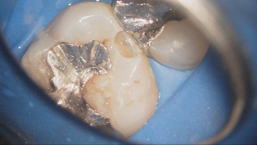 健康な歯質はほとんど削らず、ミニマムな処置