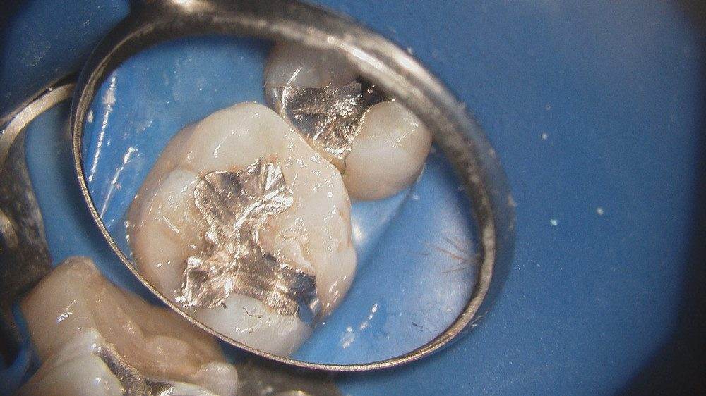 虫歯を除去した部位のみを、コンポジットレジンで埋めて終了