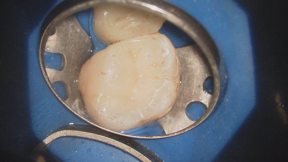 レジン系接着剤で接着。適合精度も完璧