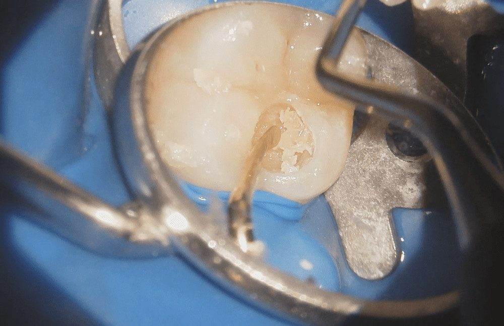 健全な歯質を削らないよう、スプーンエキスカベーターを使用してう蝕除去