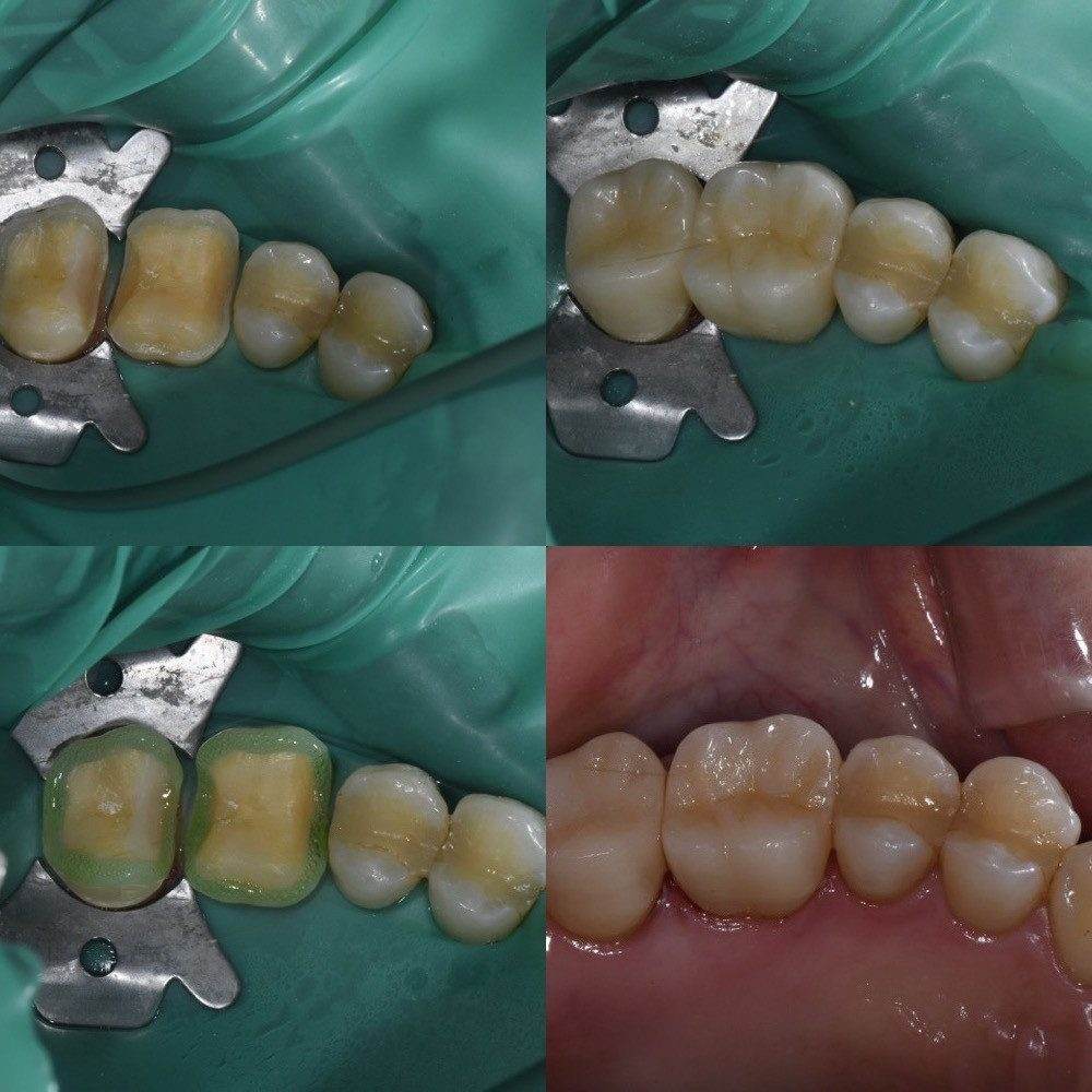 Hatch Dental Clinicのオクルーザルベニア修復