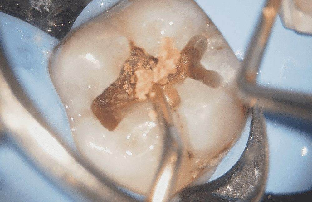 健全な歯質は削らないように、スプーンエキスカベーターを使用して虫歯を除去