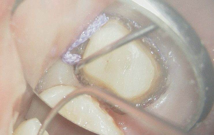 セラミック修復物などの型取りにはより精度が求められるため、圧排糸で境目をはっきりさせる必要がある