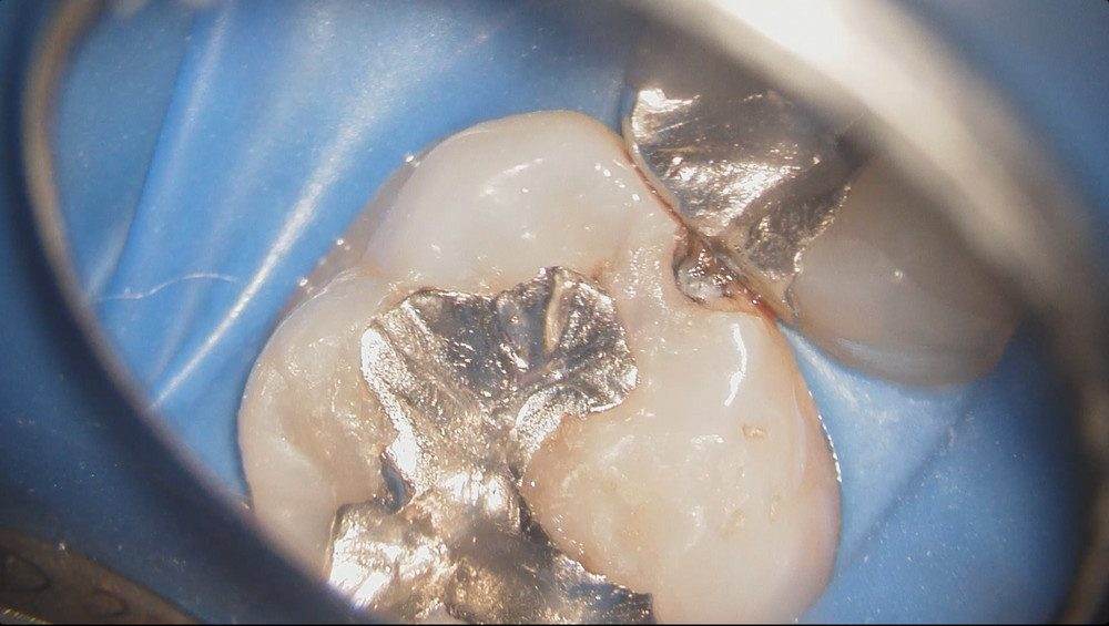 歯と歯の間に小さな虫歯(コンタクトカリエス)