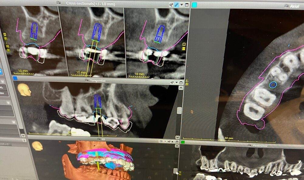 Hatch Dental ClinicのCT画像上でインプラントを設計