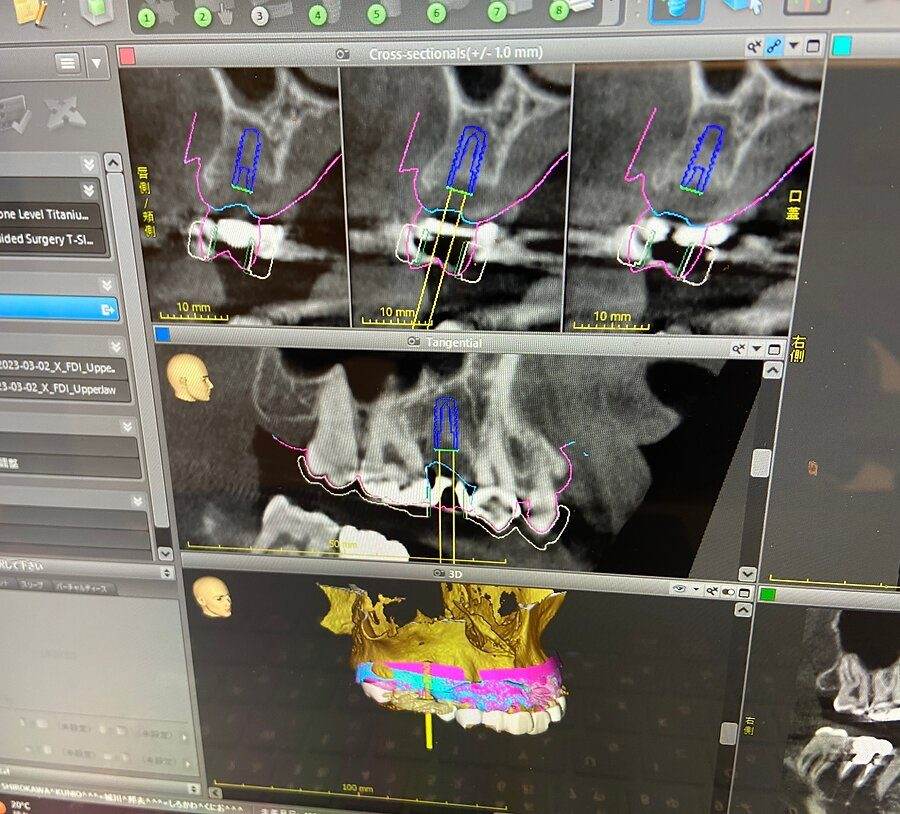 Hatch Dental Clinicのサージカルガイドの設計