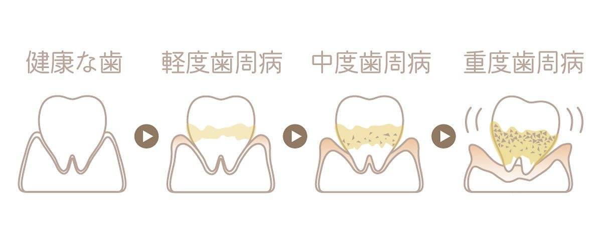  Hatch Dental Clinic 歯周病の進行