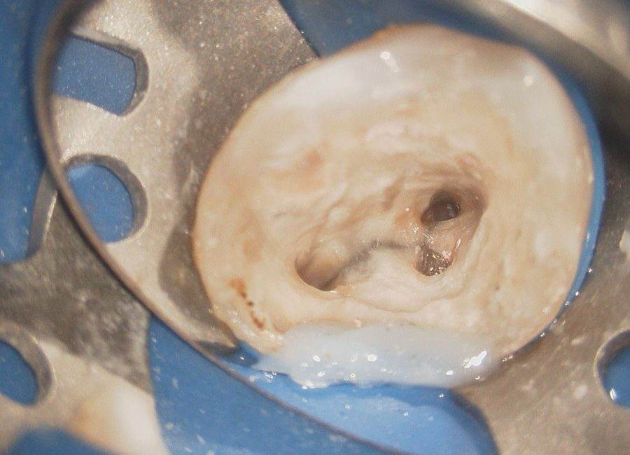 Hatch Dental Clinicのラバーダム防湿