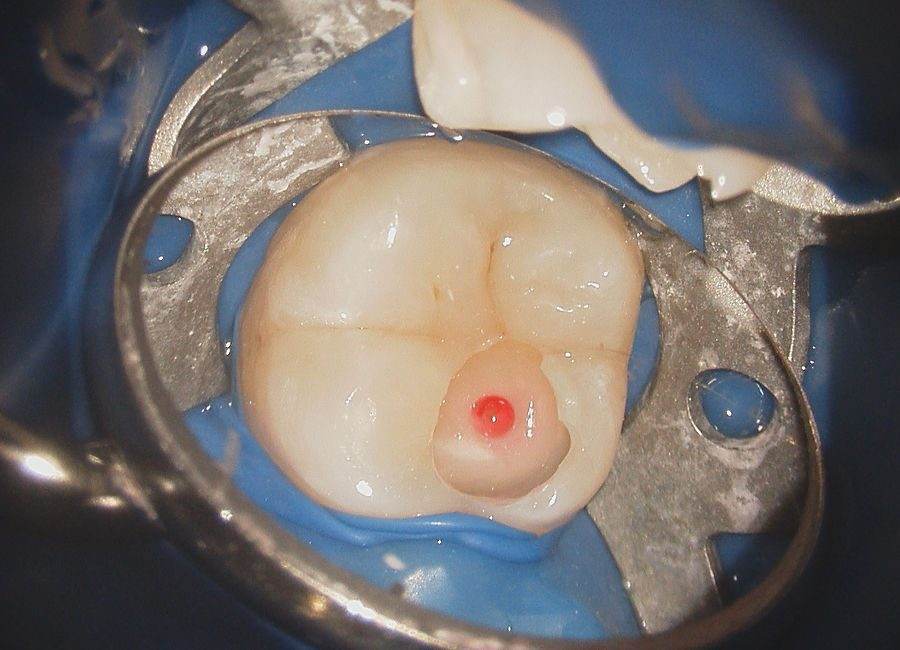 Hatch Dental Clinicでのラバーダム防湿下でのむし歯（う蝕）治療。