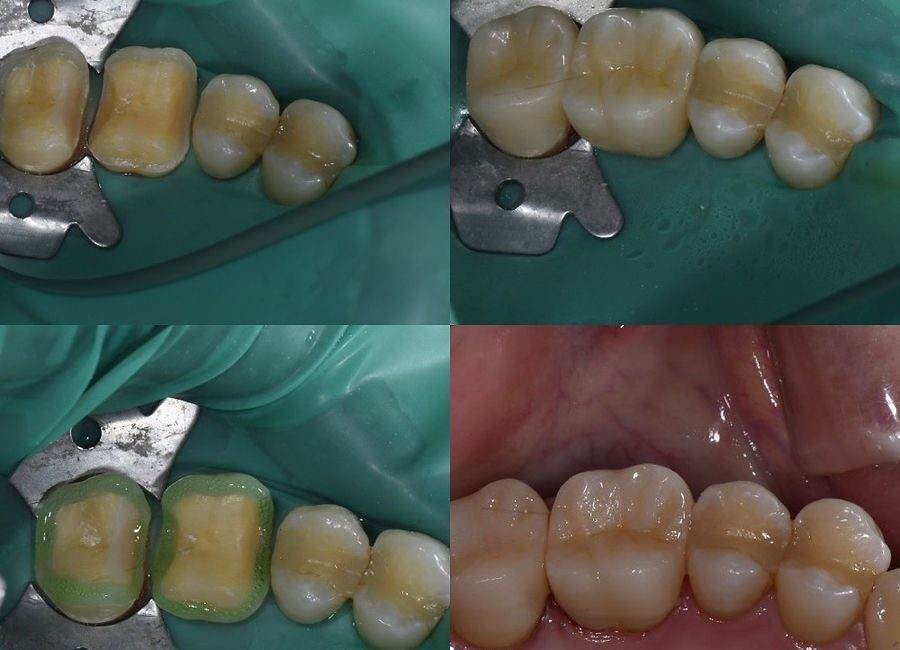 Hatch Dental Clinicでのオクルーザルベニア接着時写真。
