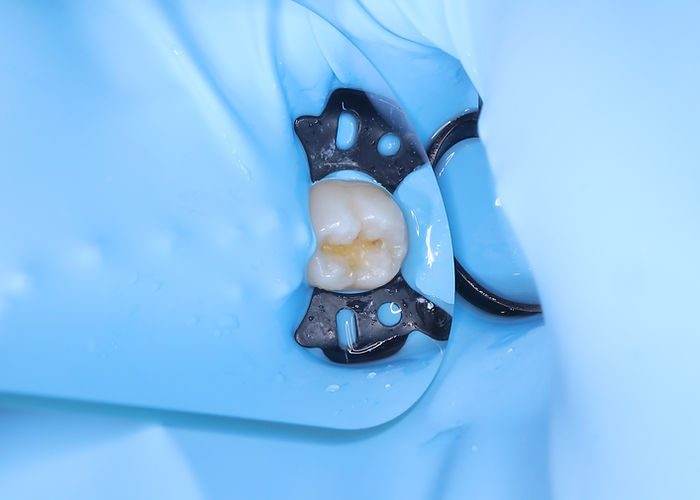 ラバーダム防湿下によるう蝕処置。コンポジットレジンおよびカリエス除去後の写真