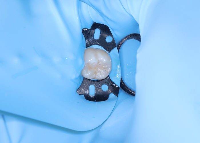 ラバーダム防湿下によるコンポジットレジン修復後の写真。防湿により精度の高い接着処理が行え、コンポジットレジンの物性も落ちない。