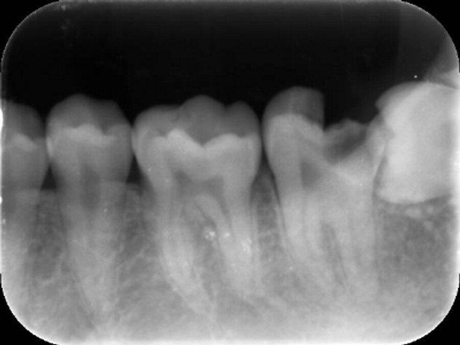 重度のう蝕により保存が難しいと判断、後方の智歯(親知らず)を用いて移植を行なった