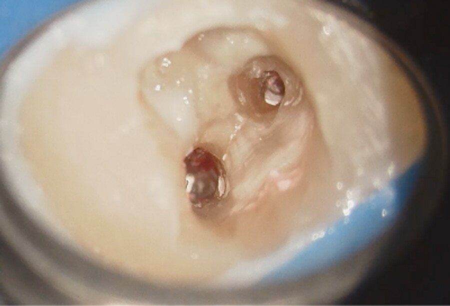 Hatch Dental Clinicの抜歯回避の症例1