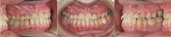 Hatch Dental Clinicの精密審美義歯の症例