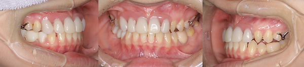 Hatch Dental Clinicの精密審美義歯の症例