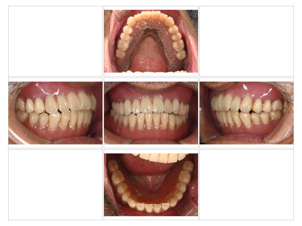 Hatch Dental Clinicのインプラントオーバーデンチャー症例の治療後1年経過時の口腔内写真