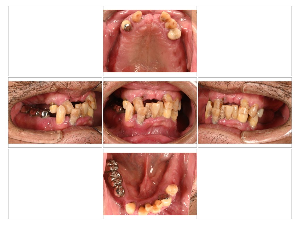 Hatch Dental Clinicのインプラントオーバーデンチャー症例の治療前口腔内写真