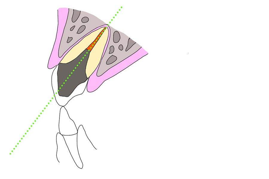 歯髄を取ってしまうことで無理やり内側に角度を変えられる