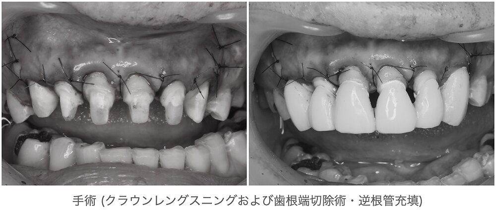 審美歯科症例クラウンレングスニングおよび歯根端切除、逆根管充填(外科的歯内療法術)