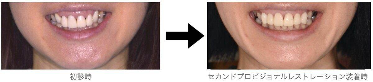審美歯科症例。初診時とセカンドプロビジョナルレストレーション装着時の比較