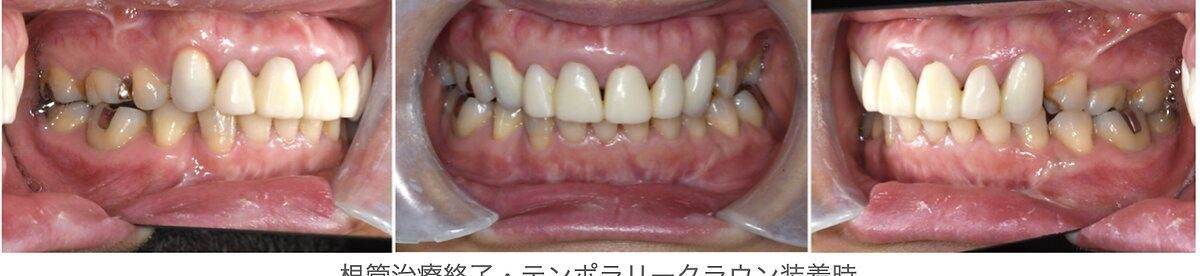 審美歯科失敗症例。根管治療終了後、テンポラリークラウン装着
