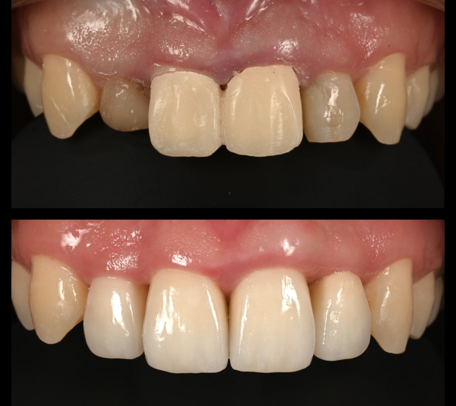 Hatch Dental Clinicの審美歯科治療、ビフォーアフター